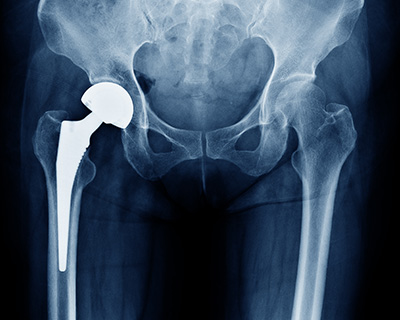 人工股関節置換術