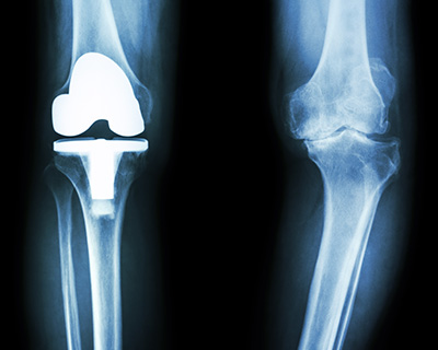 人工膝関節置換術
