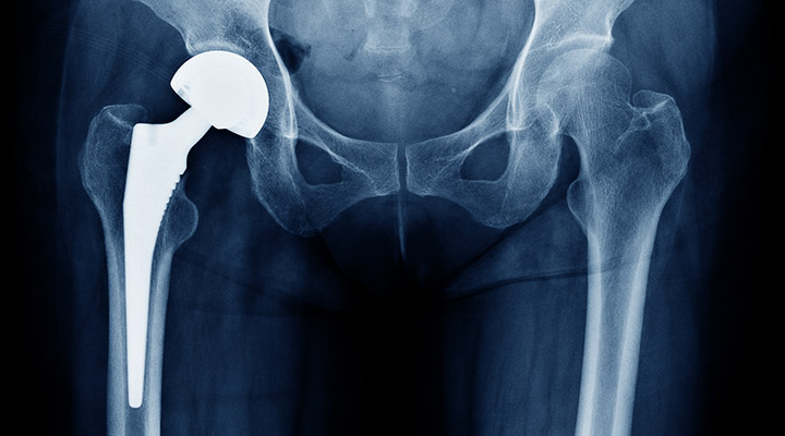 人工股関節置換術