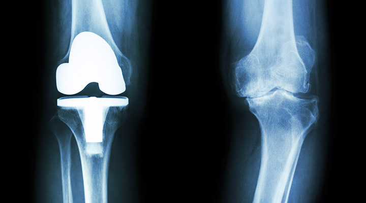 人工膝関節置換術